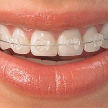 Indirekt bracket sablonok