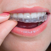 Clear aligner sínek
